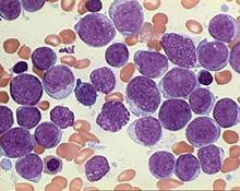 Leukemia: abnormal WBC proliferation