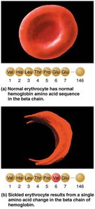 Sickle cell disease: abnormal RBC shape