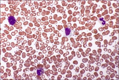 Polycythemia: increased RBC count