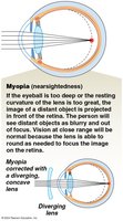 Myopia (nearsightedness) diagram
