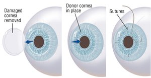 Corneal transplant steps