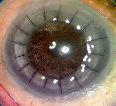 Corneal transplant with sutures