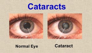 Normal eye vs cataract
