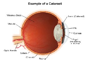 Anatomy of a cataract