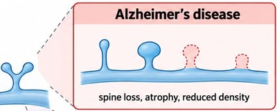 Alzheimer's disease: dendritic spine loss