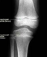 Epiphyseal plate in bone
