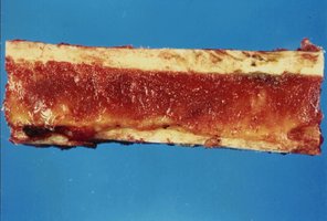 Red and yellow bone marrow