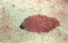 Freckles, moles, and albinism