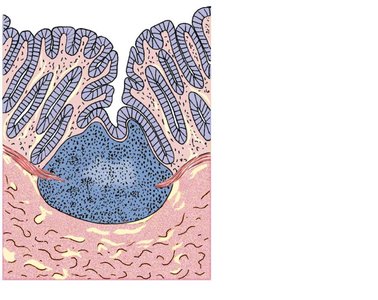 Aggregated lymphoid nodule in intestinal mucosa