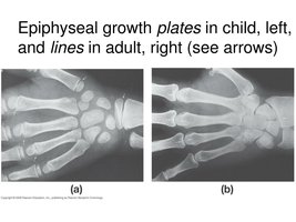 Epiphyseal growth plates in child and adult