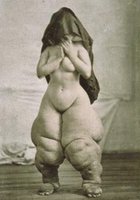 Severe lymphedema (elephantiasis)