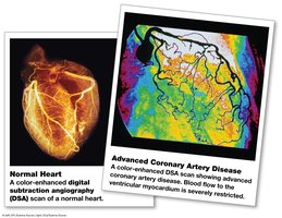 Normal heart and advanced coronary artery disease