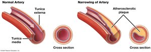 Atherosclerotic plaque in artery