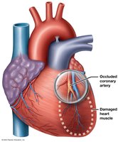 Myocardial infarction: occluded artery and damaged muscle