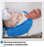 Electrode placement for ECG