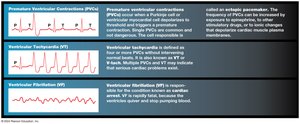 Cardiac arrhythmias examples