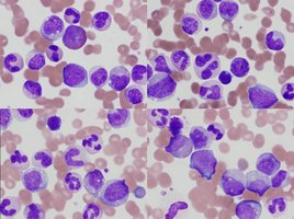 Leukemia blood smear