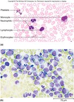 Acute monocytic leukemia blood smear