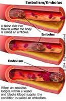 Embolism: clot traveling and blocking vessel