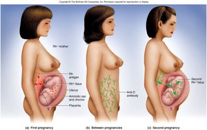 Hemolytic disease of the newborn: Rh incompatibility