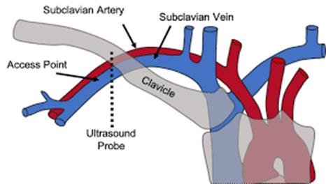 Subclavian artery and vein access point
