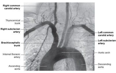 Aortic arch and major branches