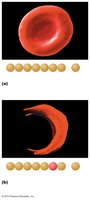 Normal vs. sickle-cell erythrocyte