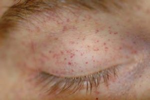 Petechiae from thrombocytopenia