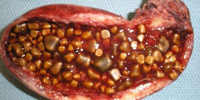 Gallstones in the gallbladder