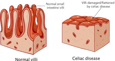 Normal villi vs. villi in celiac disease