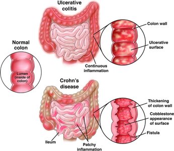 Ulcerative colitis vs. Crohn's disease