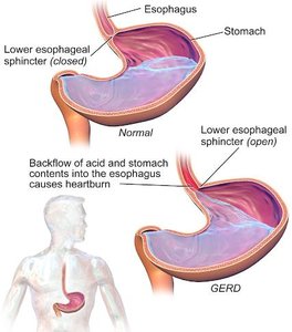 Heartburn and GERD mechanism