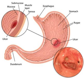 Stomach ulcer location and appearance