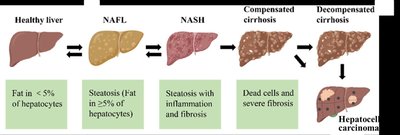 Progression of NAFLD to cirrhosis and cancer