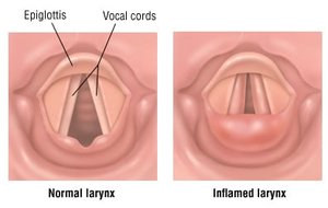 Normal vs. inflamed larynx