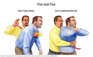 Five-and-five method for choking