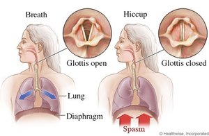 Hiccup mechanism
