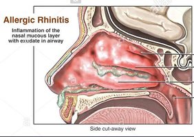 Allergic rhinitis: inflammation of the nasal mucosa