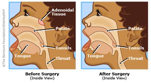 Adenoidal tissue before and after surgery