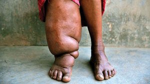 Severe lymphedema of the leg