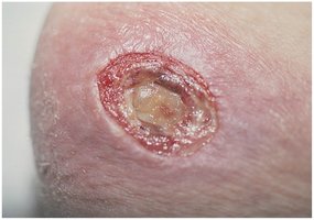 Deep decubitus ulcer (stage III)