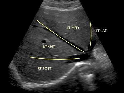 Ultrasound image showing liver segments