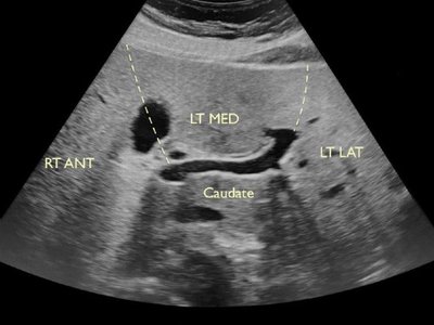 Ultrasound image showing caudate lobe and liver segments