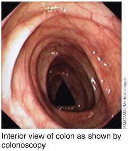 Colonoscopy view of colon