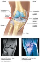 MRI of unhappy triad knee injury
