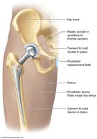 Hip joint replacement prosthesis