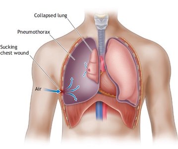 Pneumothorax and collapsed lung