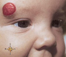 Strawberry hemangioma on a child's face