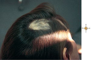 Alopecia areata showing patchy hair loss on the scalp