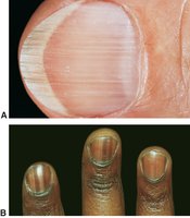 Normal variations in nail structure: longitudinal ridges and pigmented bands